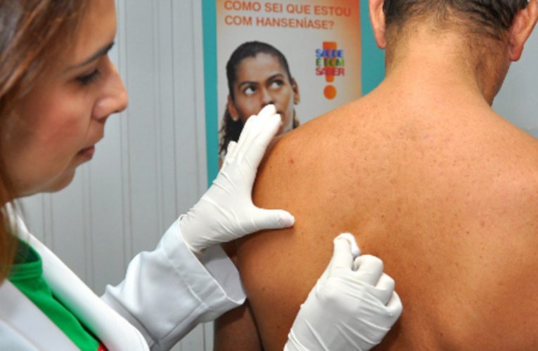 Hanseníase tem cura e tratamento é gratuito nos postos de saúde de Fortaleza